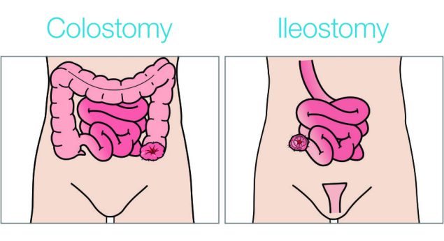 دستگاه گوارش و عملكرد آن (کولوستومی و ایلئوستومی)