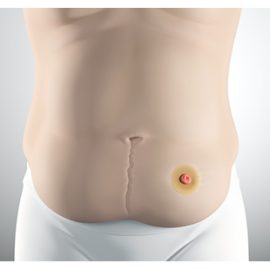 تفاوت بین استومی (Ostomy) و استوما (Stoma)