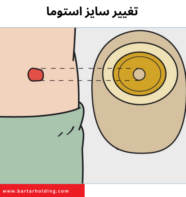 مشکلات ناشی از عدم تطابق سایز برش چسب و استوما