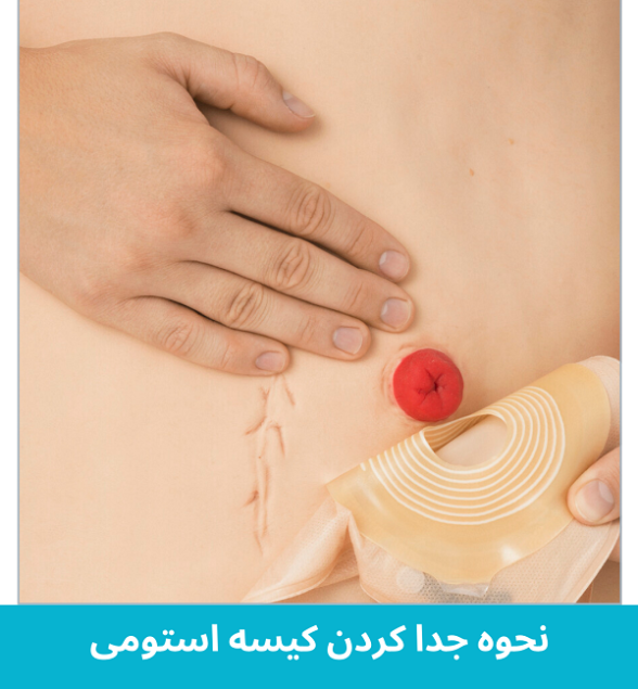 ­­نحوه چسباندن کیسه استومی