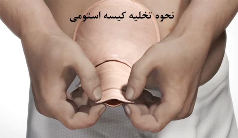 نحوه تخلیه کیسه استومی