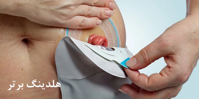 همه چیز درباره جزئیات عوض کردن کیسه استومی