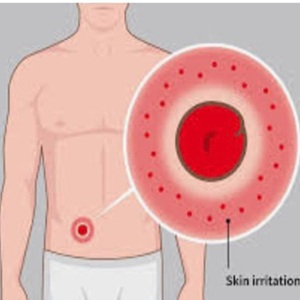 عفونت کیسه استومی