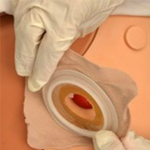 بوی بد کیسه استومی