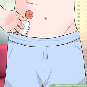آموزش گامبهگام تعویض کیسه استومی در منزل